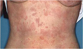 ぎんなん皮膚炎 - 川口皮膚科クリニック