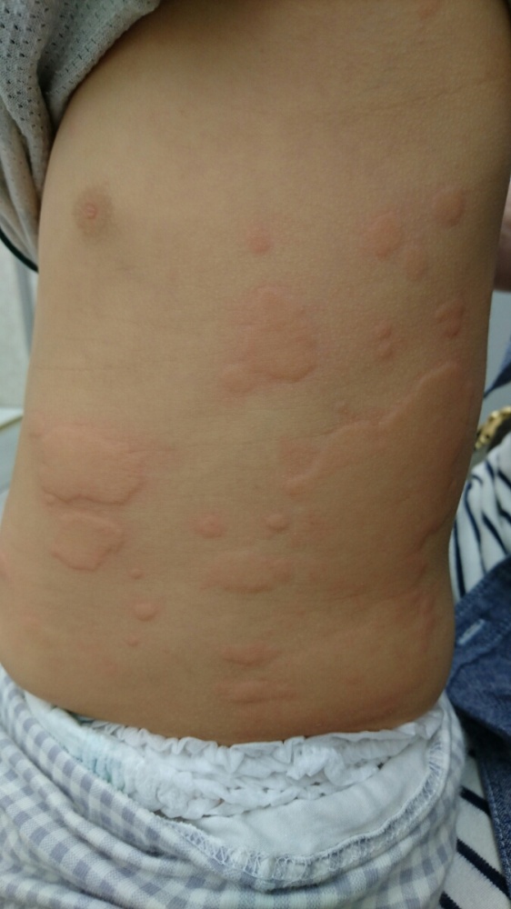 赤ちゃんの背中や首にあせも！そのままで治る？それとも病院に連れていく？ - 株式会社エバーセンス