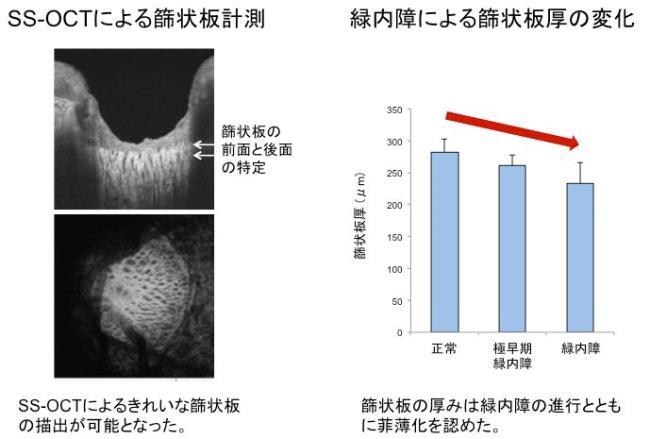 視神経症 視神経炎 日本眼科学会による病気の解説