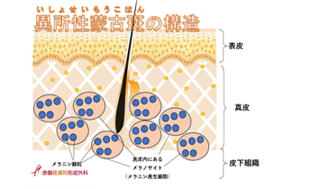 岡山で異所性蒙古斑なら当院へ MONGOLIAN SPOTS