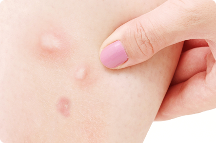 虫刺され対策と治療子どもはとびひに注意あさ美皮フ科亀戸駅前