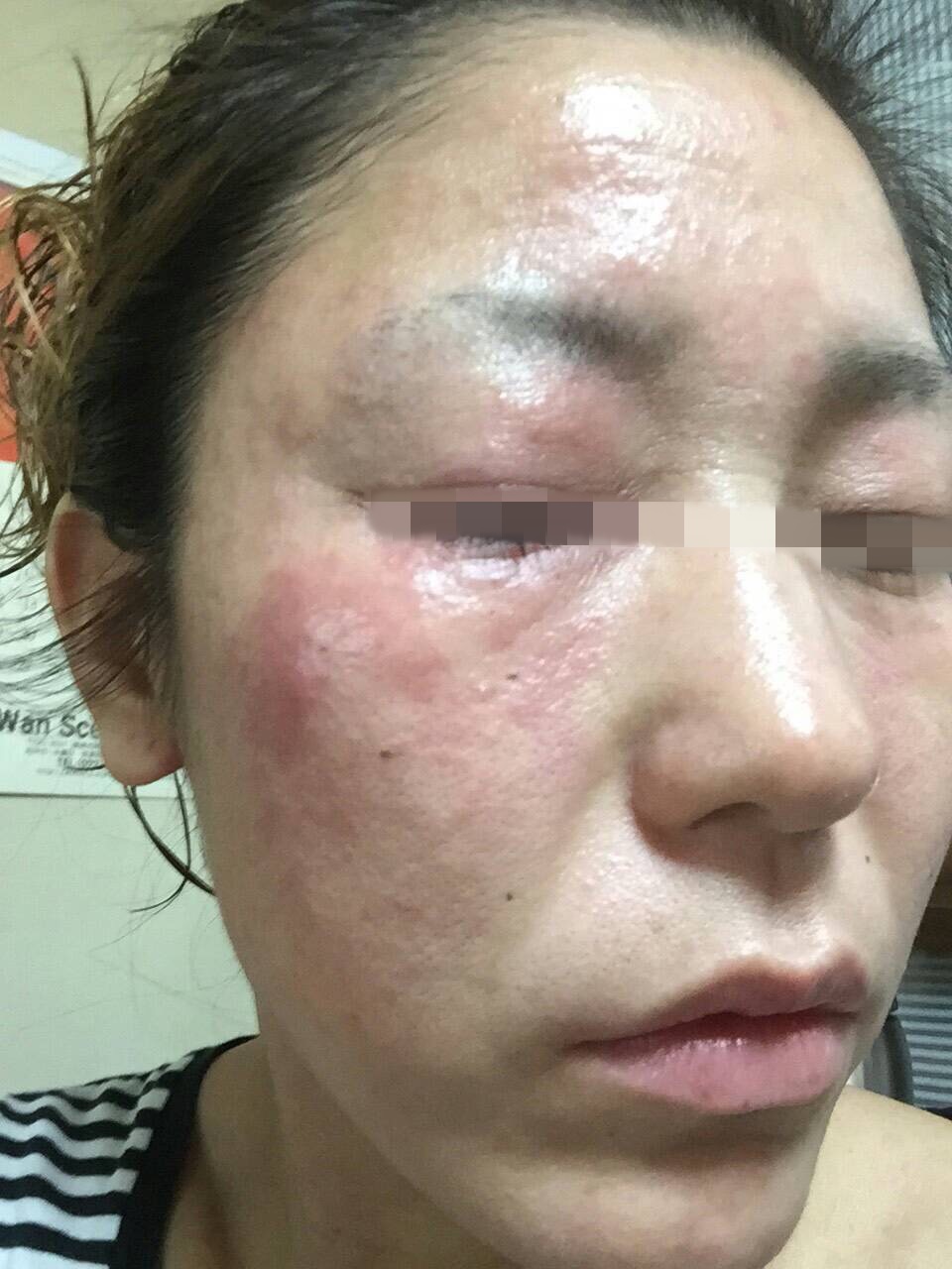 赤ら顔 - 学芸大西口クリニック