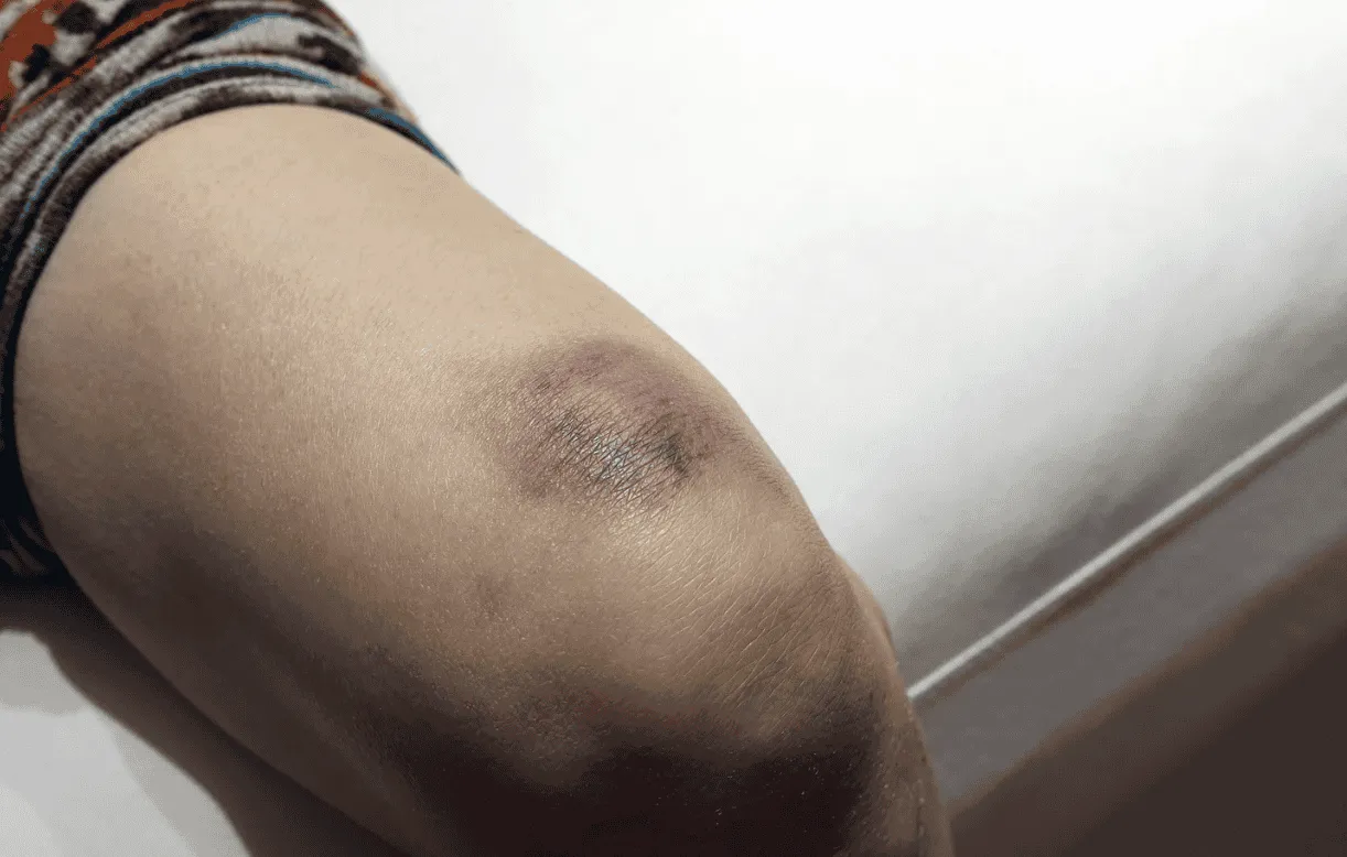 青あざができる原因や種類を解説！治療方法や早く治すための対処方法、大人になっても消えないケースも紹介