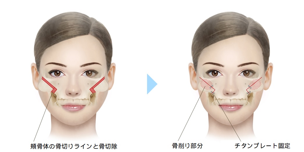 小顔矯正顎エラ頬鼻筋の非対称顔歪み専門関西プロポーション小顔センター大阪梅田院,堺市なかもず院整体顎関節症