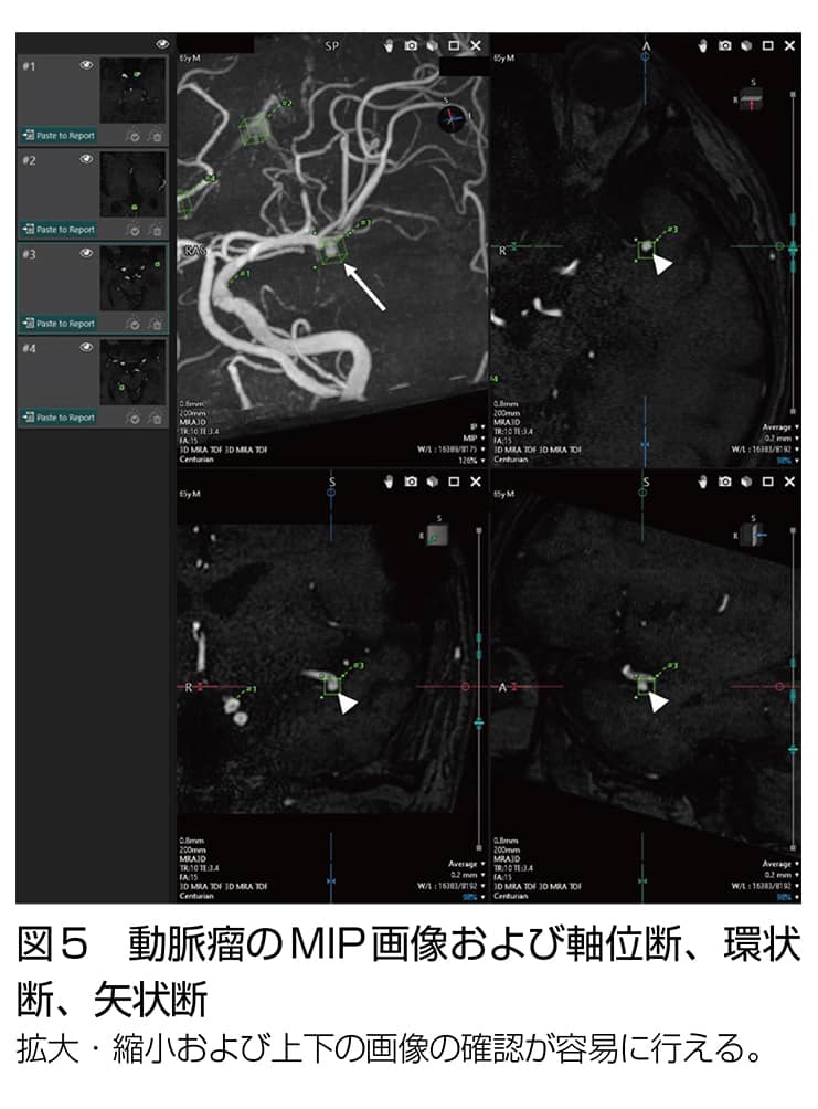 MRI MRA画像あり 脳動脈瘤の種類、頻度、好発部位、画像所見まとめ