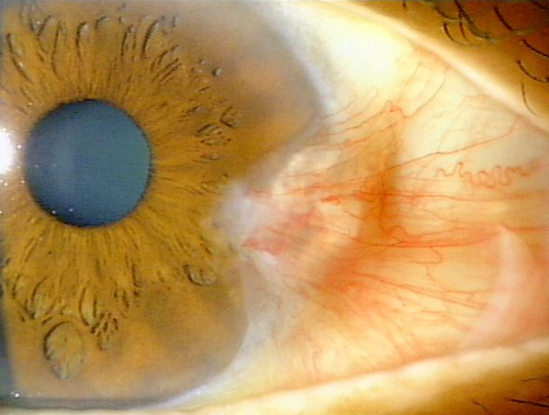 細菌性結膜炎」とは？ウイルス性との見分け方と原因・対処法大正製薬「アイリス」