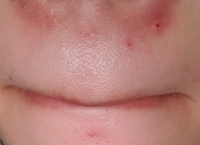 酒さってどんな病気？赤ら顔の原因や治療法を解説 - 池袋駅前のだ皮膚科