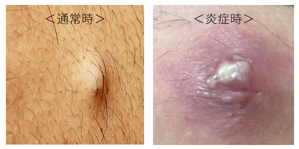 おへそ 臍 から膿がでて、臭う・痛いこだいら泌尿器科