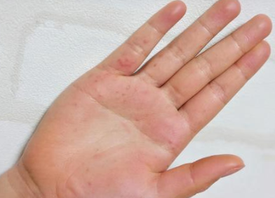 がんとほくろを見分ける方法はある？疑うポイントと治療法がんメディ