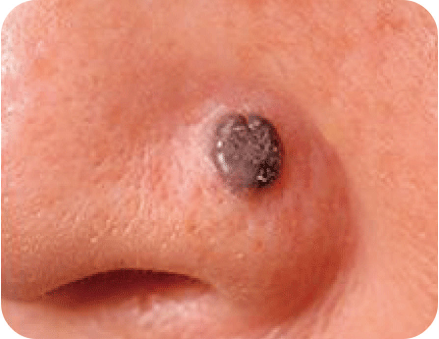 子宮頸がんの治療│近畿大学病院