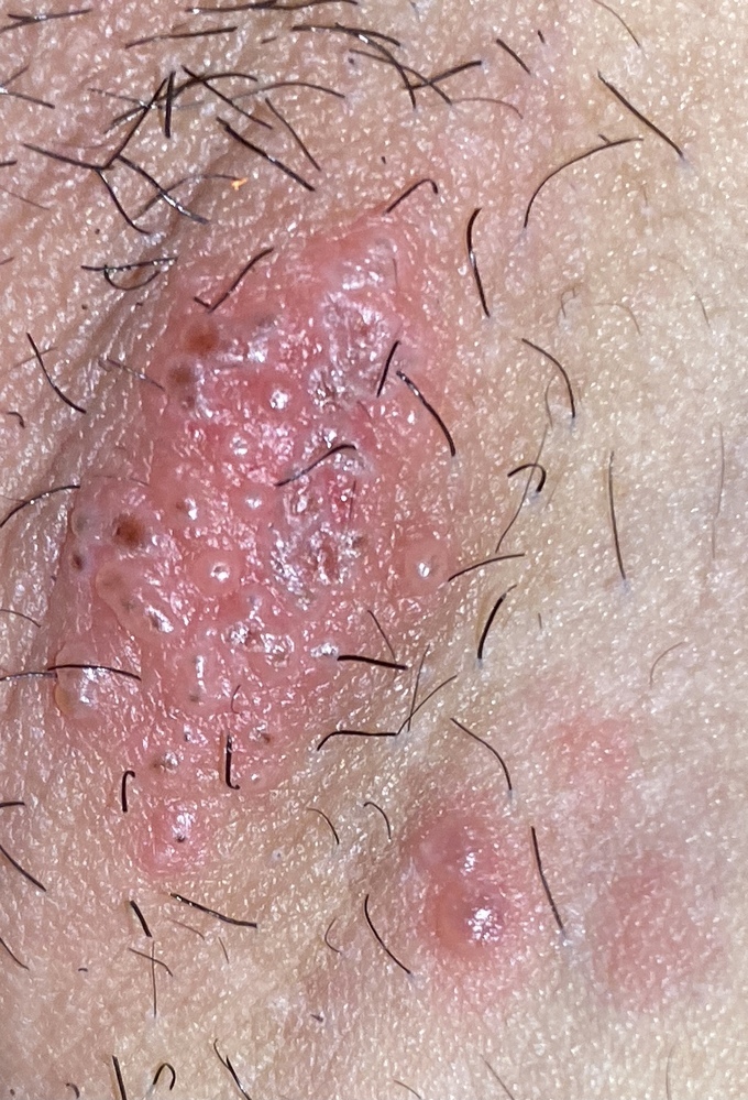 毛嚢炎 毛包炎 とは？原因や対処方法を解説美容脱毛サロン ミュゼプラチナム