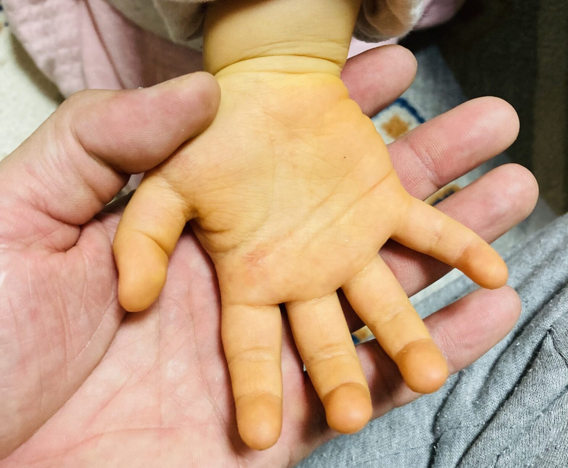 生後1ヶ月 赤ちゃん 黄疸の写真素材12286759- PIXTA