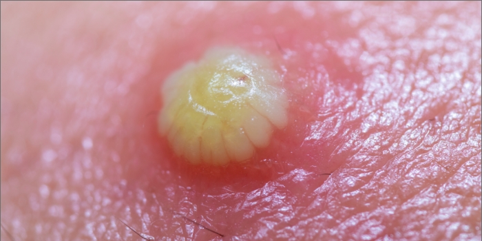 鼻ニキビを即効で治すには？原因と治し方を美容皮膚科医が解説！恵比寿駅徒歩1分の美容皮膚科ATELIER MedicalClinic アトリエメディカルクリニック