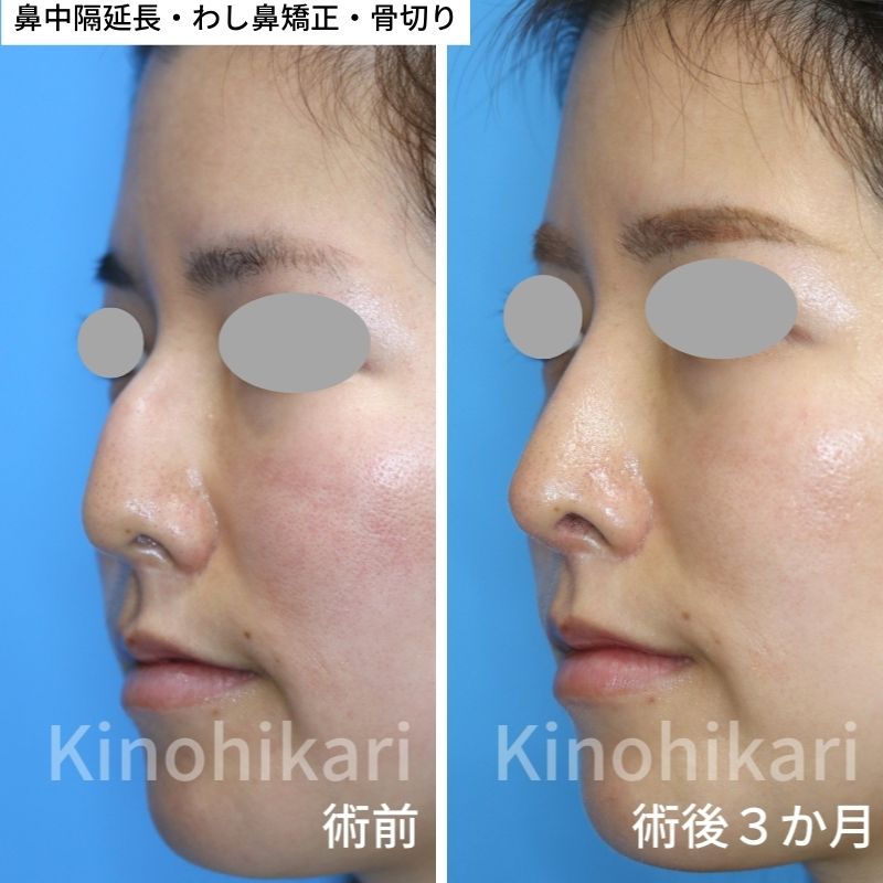 鼻整形・形成術 鼻の曲がり 斜鼻 鼻中隔弯曲症、鞍鼻の治療受け口などの顎変形症、あごえら・小顔矯正・性同一性障害の顔面輪郭、鼻整形、顔面変形、睡眠時無呼吸症候群の形成美容外科専門治療：東京警察病院形成外科・美容外科