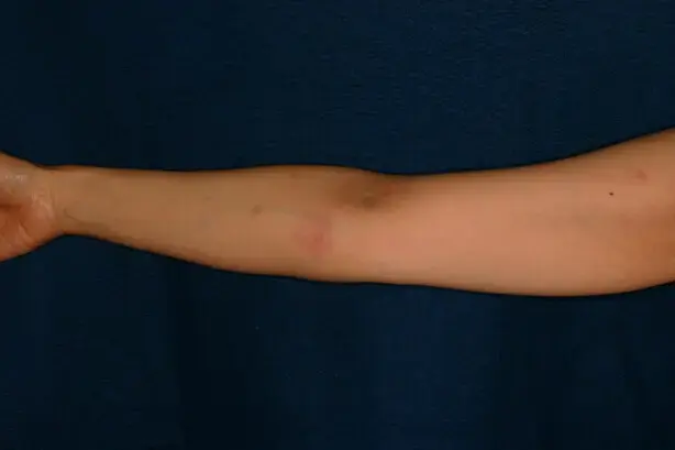 無視してはいけない虫刺され14選 症状別の画像で確認