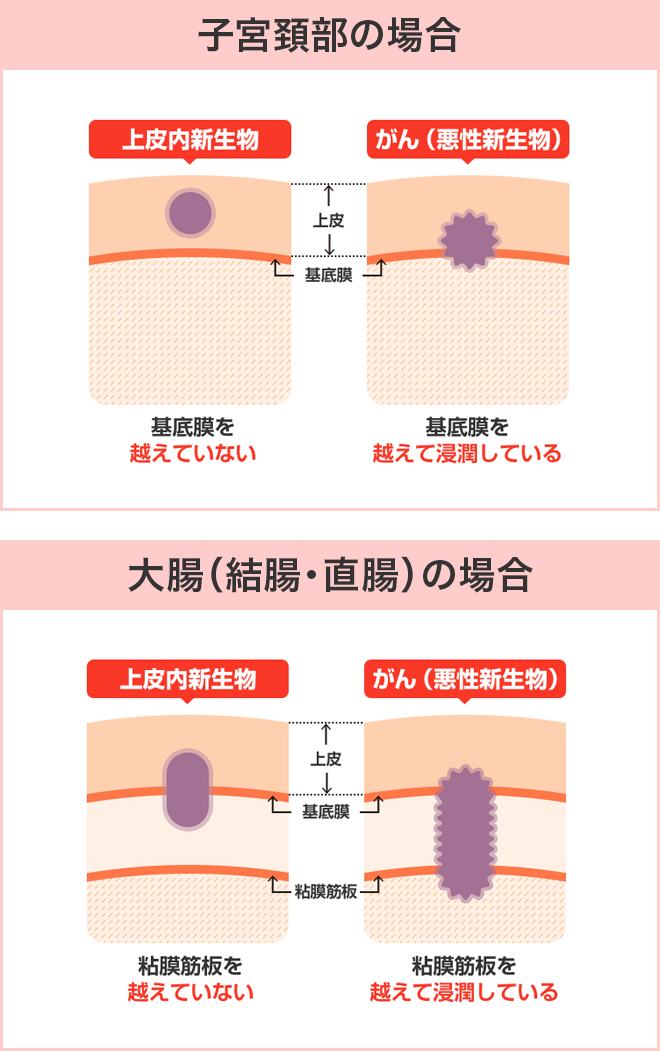 上皮内新生物 上皮内がん と悪性新生物 がん の違いは？保険選択時のポイントを解説 - オカネノホンネ保険・金融メディア