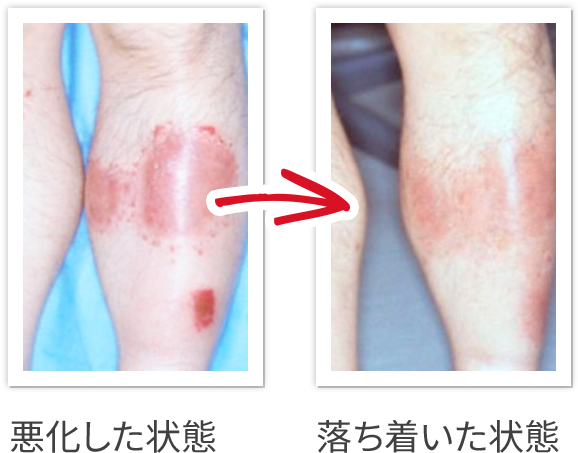 頭皮乾癬怎麼辦？醫師曝4大療法，別再吃這些NG飲食