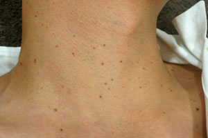 首のイボ 気になりませんか？瑞穂ゆかり皮ふ科クリニック瑞穂区の皮膚科・小児皮膚科・美容皮膚科