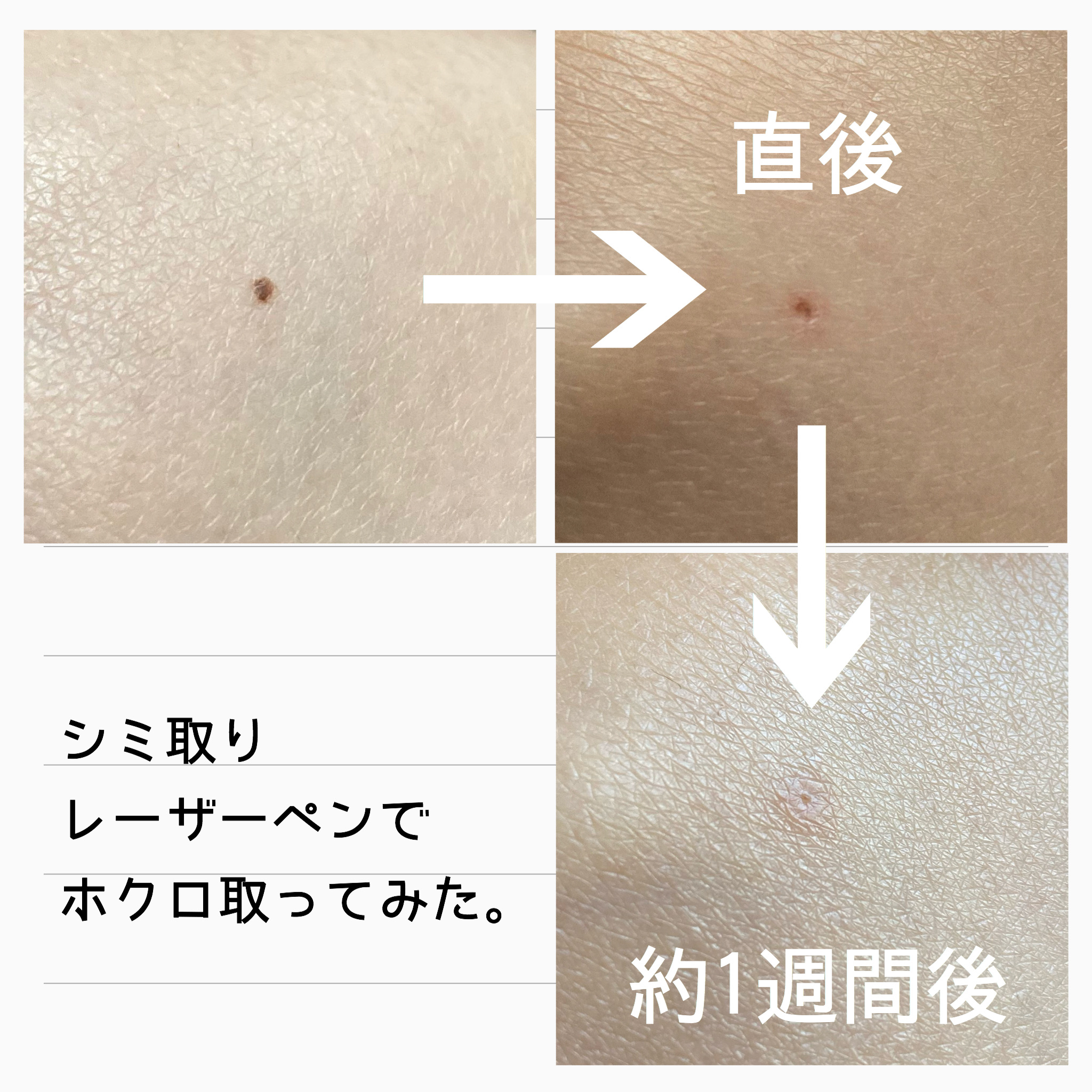 シミレーザー治療経過と処置 - 東京・大阪の美容皮膚科ならFLALU フラルクリニック