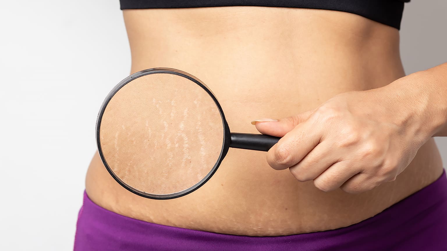 皮膚のたるみ・肉割れ・ひび割れの原因と薄くする方法