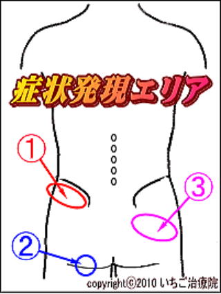 お尻の痛みの原因と予防、簡単セルフストレッチのご紹介！トレーニングあいメディアあい鍼灸院・接骨院