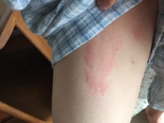 じんましん、どう対処？ 1日後改善しないなら病院に - 日本経済新聞