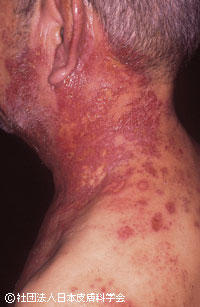 痛みに注意！頭皮にできる帯状疱疹とは。治療時の脱毛についても解説公式 ウィルAGAクリニック