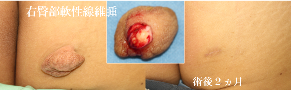 どこの病院に行くか悩んでいるうちに放置したら大きくなって。懸垂性軟線維腫は、衣服で擦れる部分になどにできる皮膚から垂れ下がっている良性腫瘍。長径数センチ程度の肌色から褐色調の有茎性で球状の軟らかいできもののこと。首に多発するものを軟性線維腫ないし