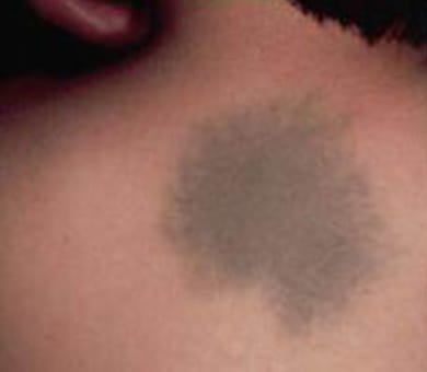 身に覚えのないあざが黄色い？考えられる原因と対処法を解説「さかぐち整骨院 -枚方市-」枚方市で口コミ評価NO.1