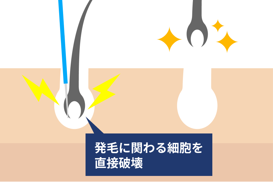 眉毛脱毛におすすめサロン&クリニックをぶっちゃけ解説失敗しない脱毛店の選び方も紹介 - カスタムライフmedical