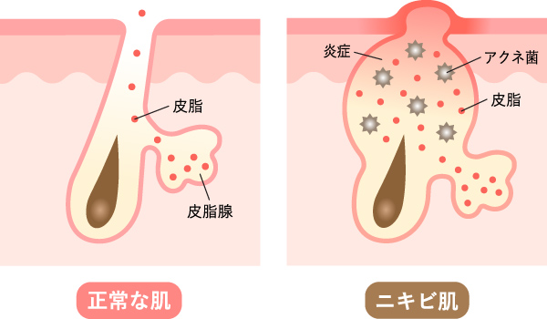 鼻ニキビの原因と治し方即効性あるケア方法や１日