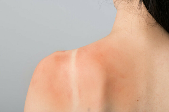 日焼けで皮がむける理由と対処法！適切なケアで皮膚を守ろう - カラリアマガジン - 香り専門メディア