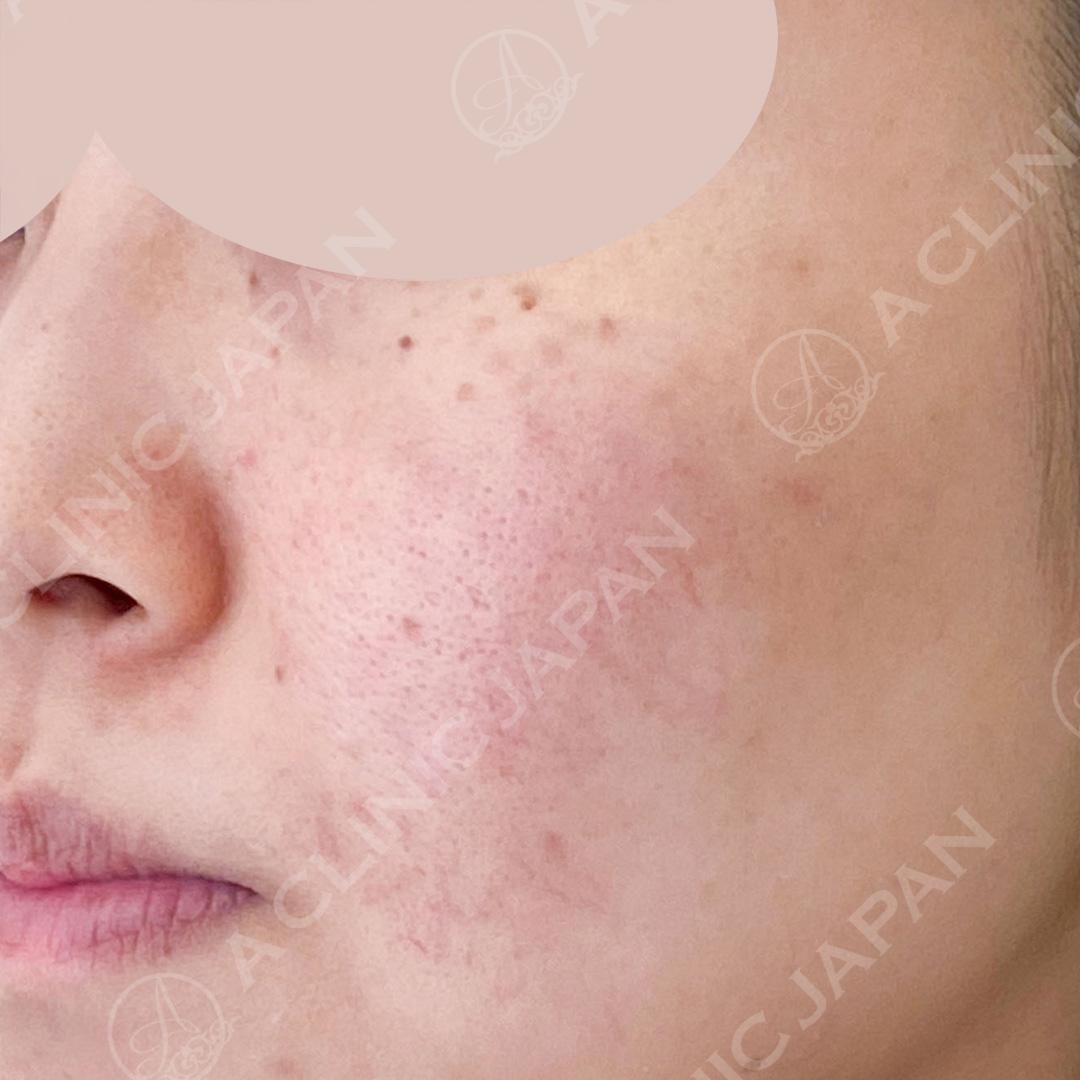 ニキビ跡治療の美容皮膚科なら城本クリニック