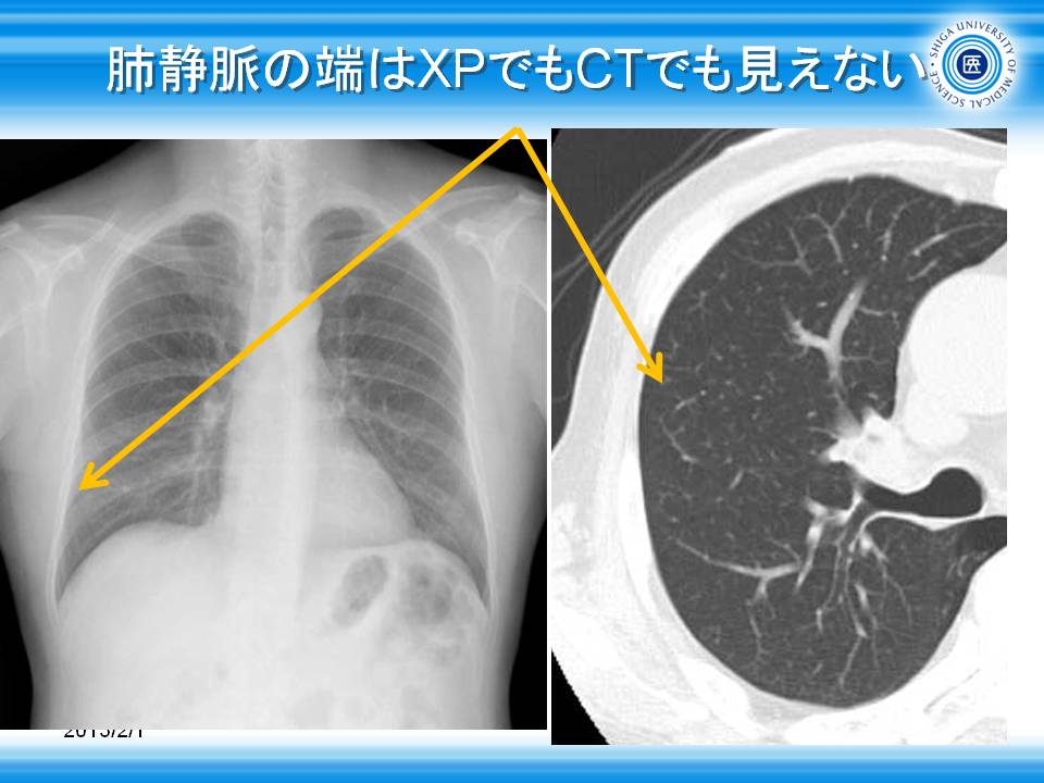 胸部レントゲン道場４１・各論１４・レントゲンで白くなる病態８・べったりと白くなる連続性の陰影・無気肺３ なんだけど気管の偏位について触れておかねば２ :やさしイイ呼吸器教室