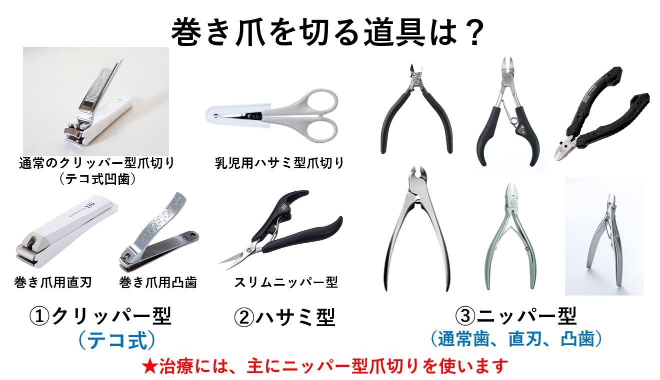 巻き爪の正しい切り方 画像付き解説 自分で足の爪を切れるようになろう！ながい接骨院