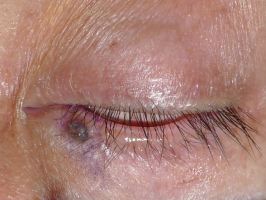 眼瞼の腫瘍
