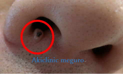 何これ？鼻の中の「白いできもの」の正体。治し方は？膿や痛みもMedicalook メディカルック