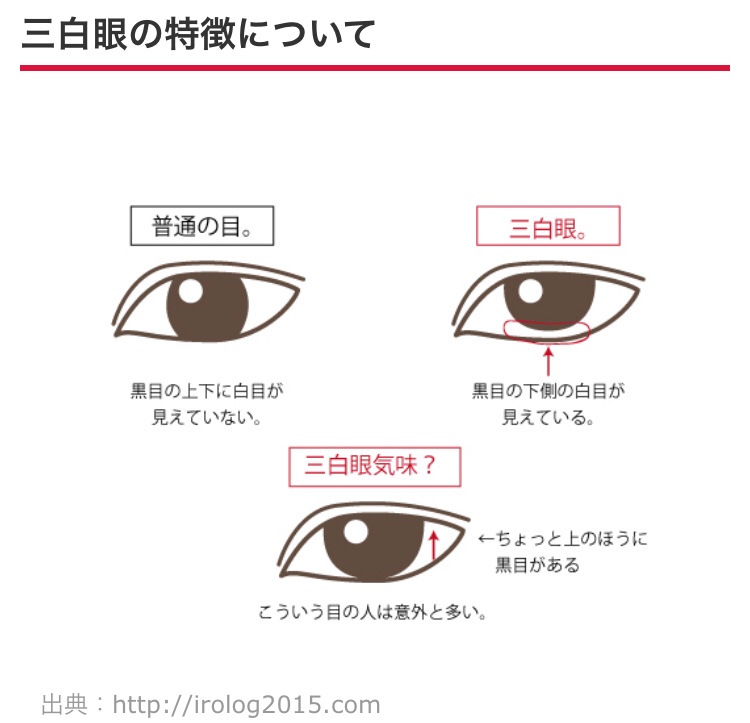 208：三白眼を改善するための外眼角固定術、目尻切開2ヶ月目の経過・レビューシウォン整形外科