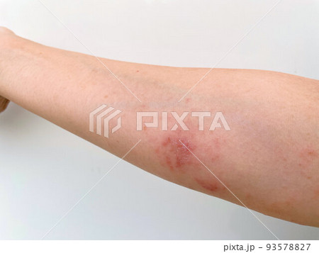 解熱した後にみられる湿疹野田市 小児科 千葉県 こどもの花粉症 こどもの漢方 喘息 アトピー性皮膚炎 アレルギー 結節性痒疹 たんぽぽこどもクリニック