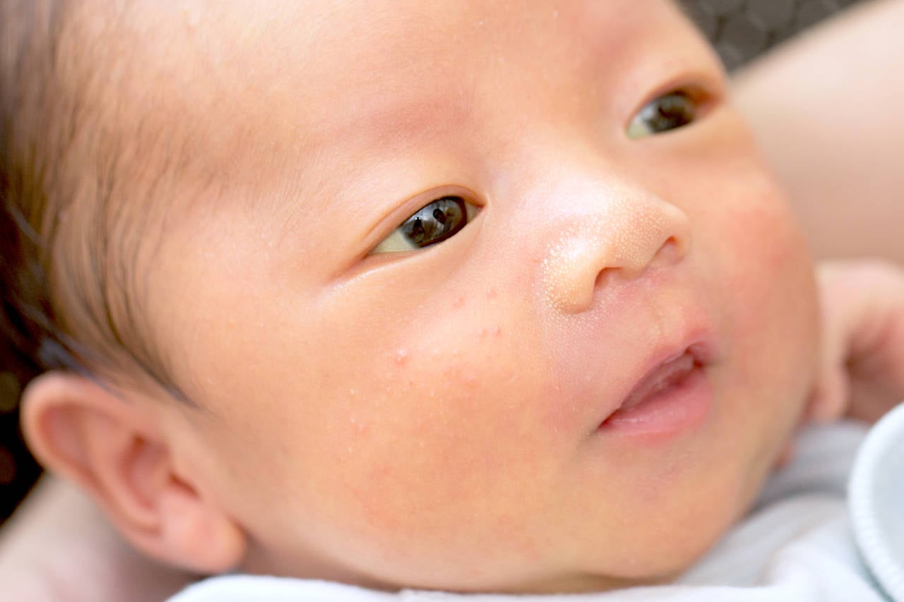 3m26d 急な湿疹に驚いた森ゆい 「賢者の婚活」 オフィシャルブログ Powered by Ameba