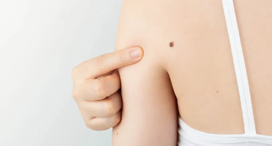 手のひらや指の皮膚が損傷し、赤くなり、ひび割れ、剥がれます。皮膚疾患。皮膚の炎症。限定フォーカス。接写。湿疹、皮膚炎、皮膚症、炎症写真素材2511702583Shutterstock