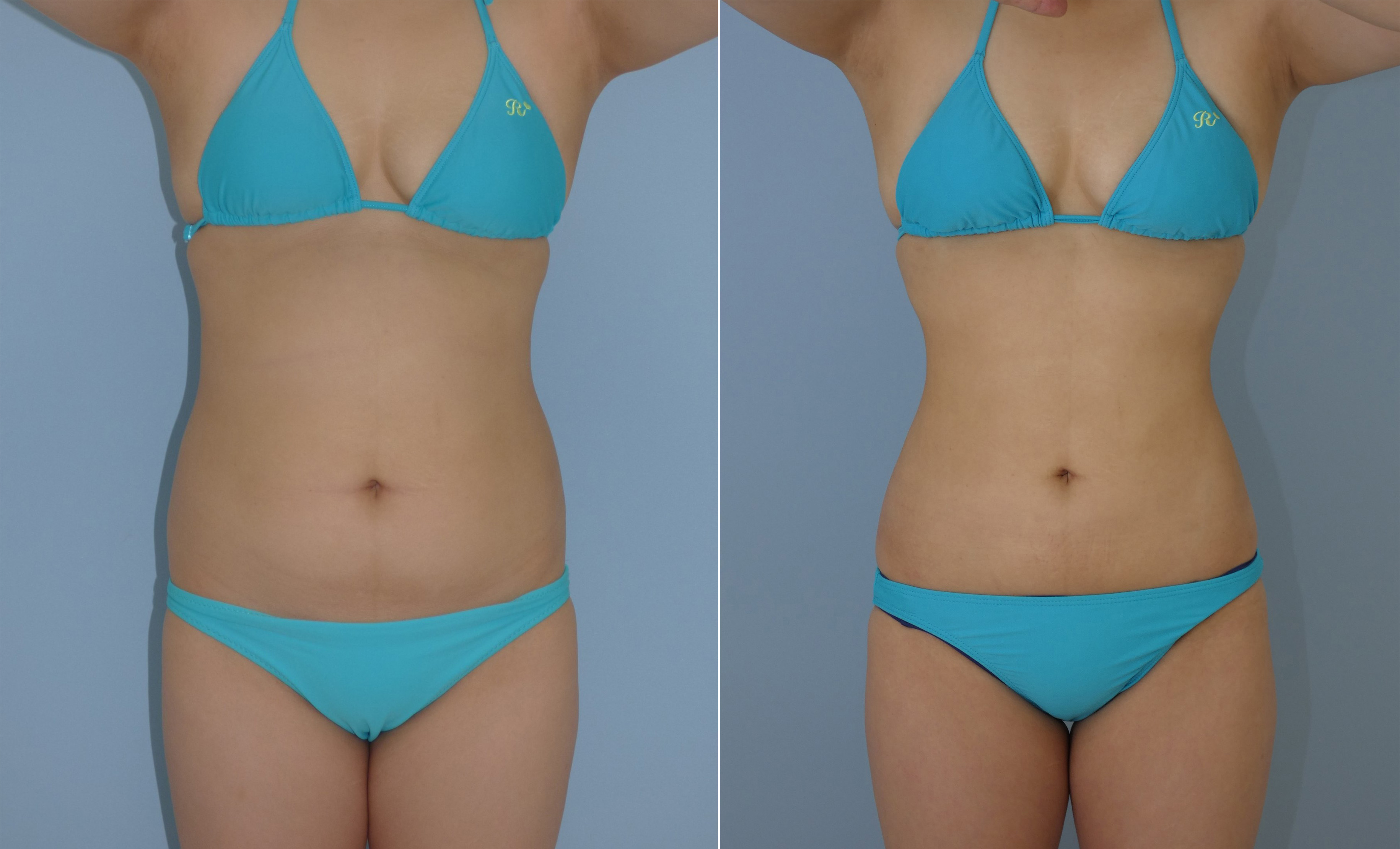 太ももの脂肪吸引 大腿全周+膝術後7か月 149㎝ 58㎏ 27歳今西理也 美容外科医ブログ脂肪吸引・豊胸・エイジング治療