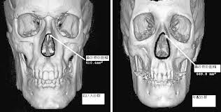 エイジングノーズ手術 老化鼻・加齢による鼻の変形修正手術 は自由が丘クリニック 公式