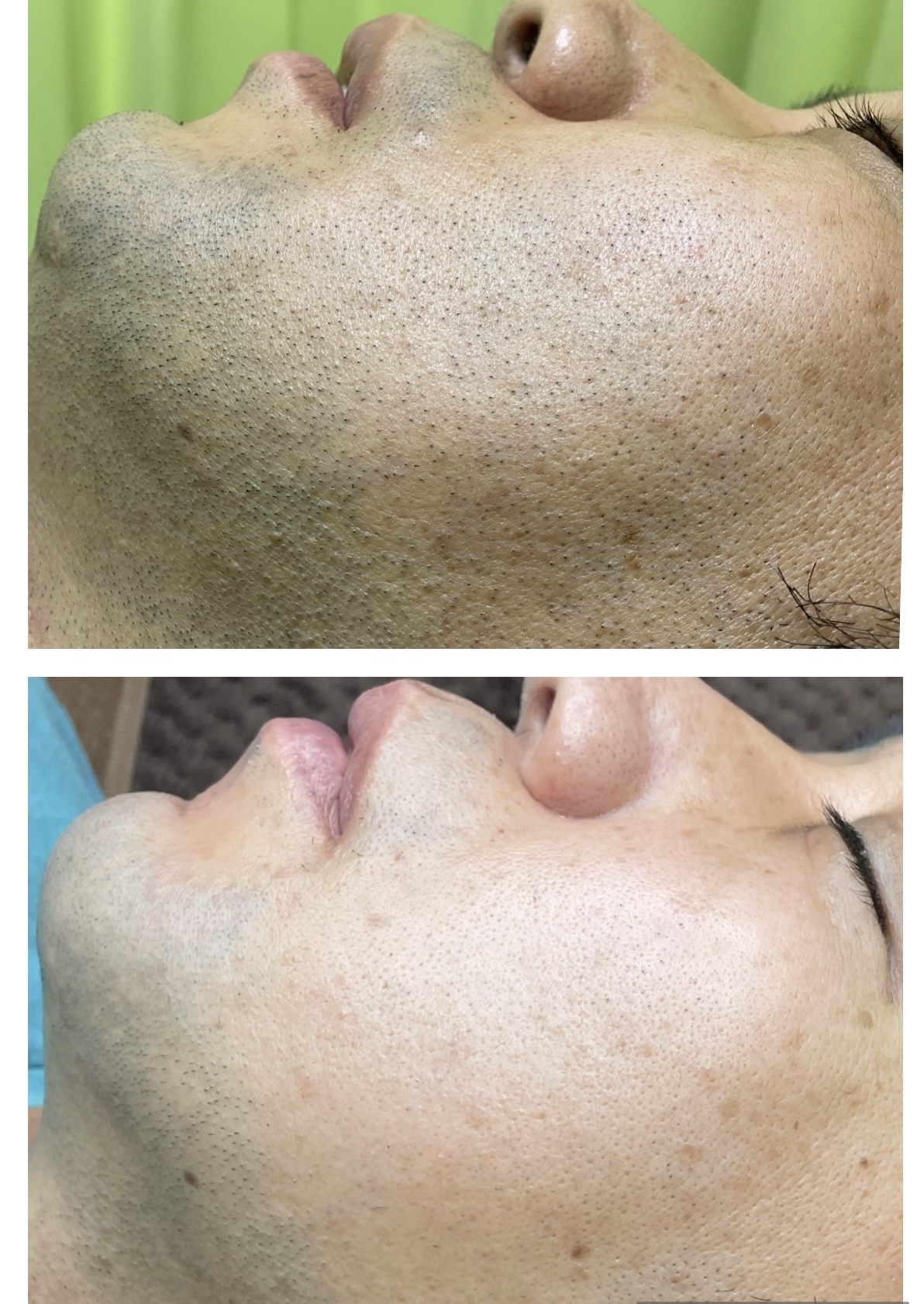 ヒゲ脱毛1ヶ月半経過〜 - AKALA 読谷店