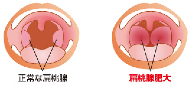 こどものいびき睡眠健康大学