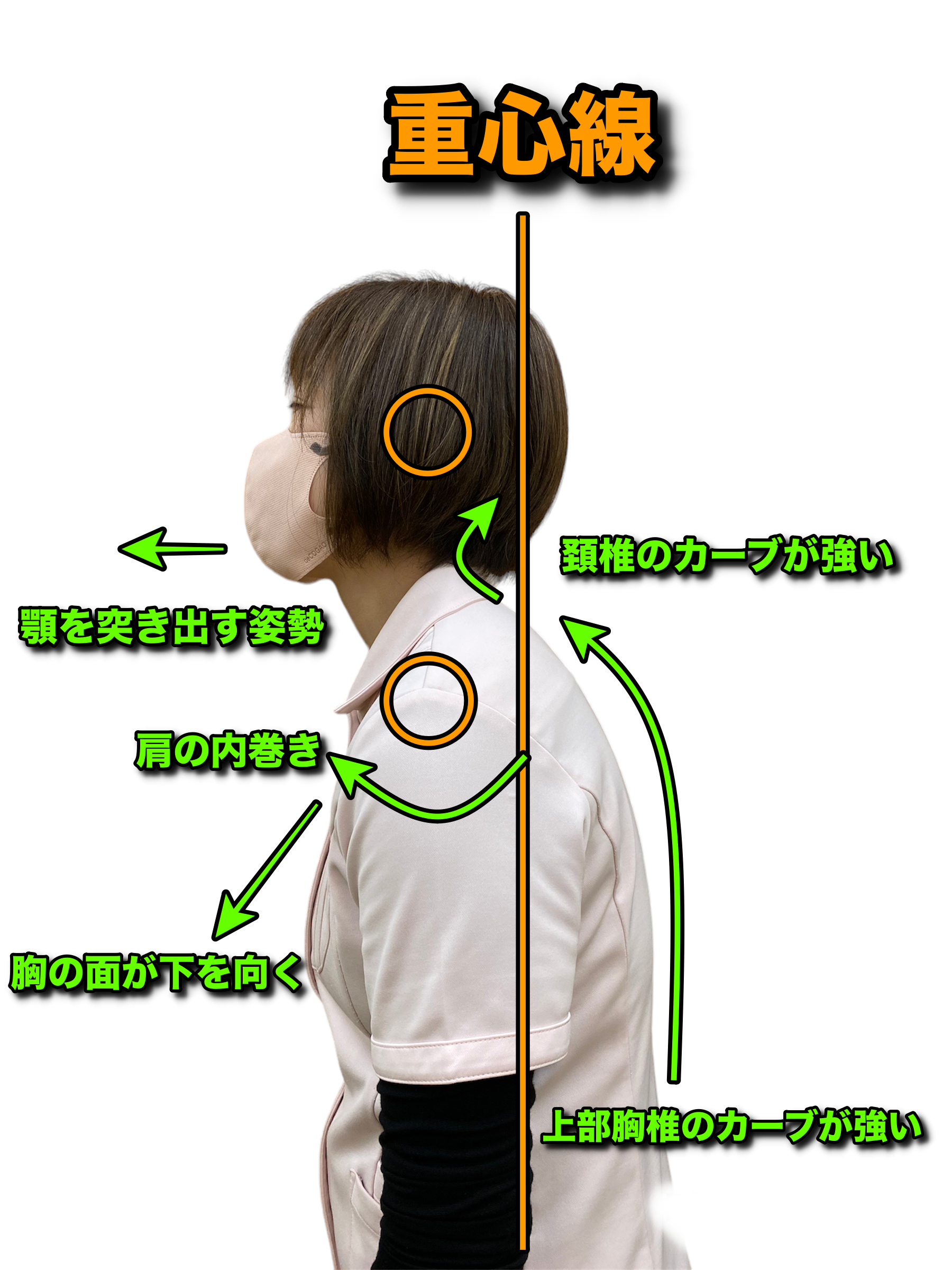 子どものストレートネック急増中！！かすが整骨院