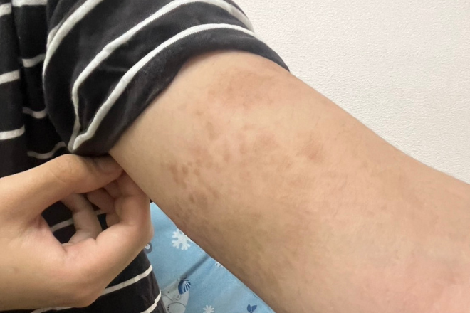 乾燥性湿疹の原因や症例画像大人も子どもも気を付けたい肌トラブル - メディプラス乾燥予防研究所