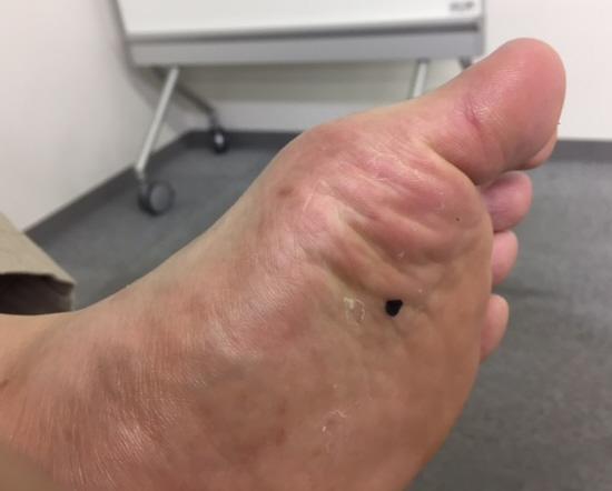 ほくろ」みたいにみえる皮膚がん 注意すべき点と見分け方 イシャチョク