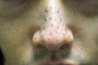 子どもの皮膚のブツブツ 湿疹 小児皮膚疾患こむらこどもクリニック