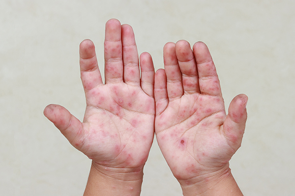 ヘルパンギーナ大正健康ナビ大正製薬